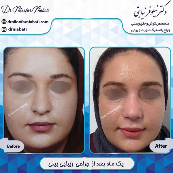 عکس قبل و بعد جراحی بینی گوشتی - دکتر نیلوفر نیابتی