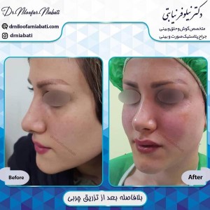 تزریق چربی صورت