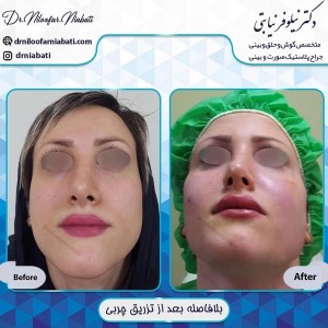 تزریق چربی صورت