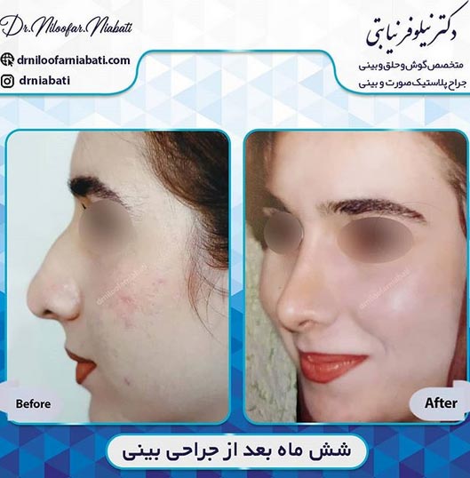 مراقبت های بعد از جراحی بینی _ دکتر نیابتی