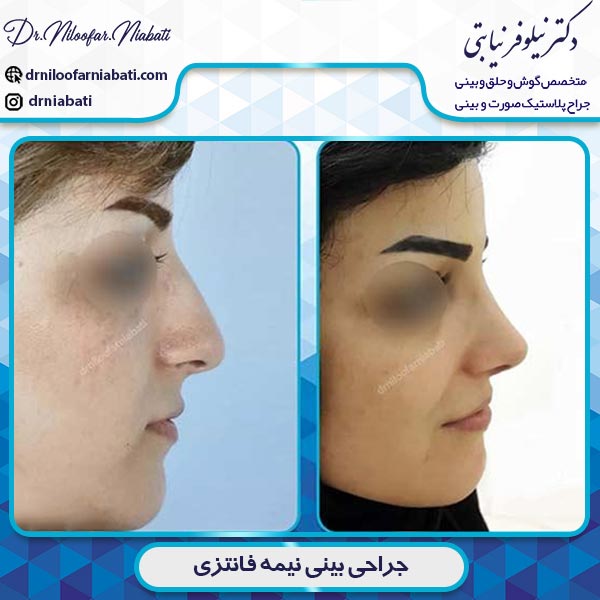 جراحی بینی نیمه فانتزی