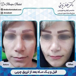 مراقبت های بعد از تزریق چربی