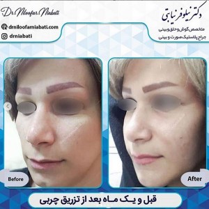 مراقبت های بعد از تزریق چربی