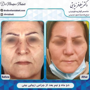 جراحی پولیپ بینی