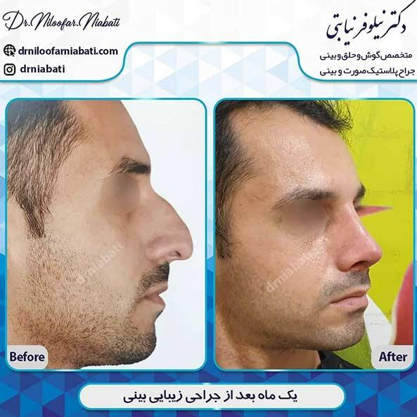 جراحی پولیپ بینی - دکتر نیلوفر نیابتی