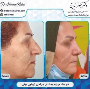 جراحی پولیپ بینی