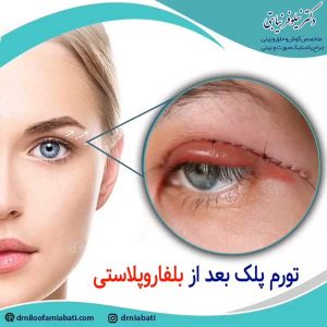 مراقبت های بعد از جراحی پلک