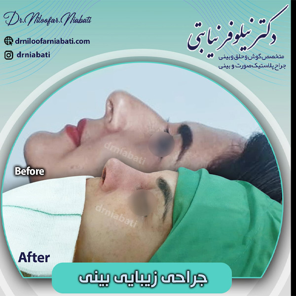 عکس قبل و بعد جراحی بینی در رامسر - دکتر نیابتی 