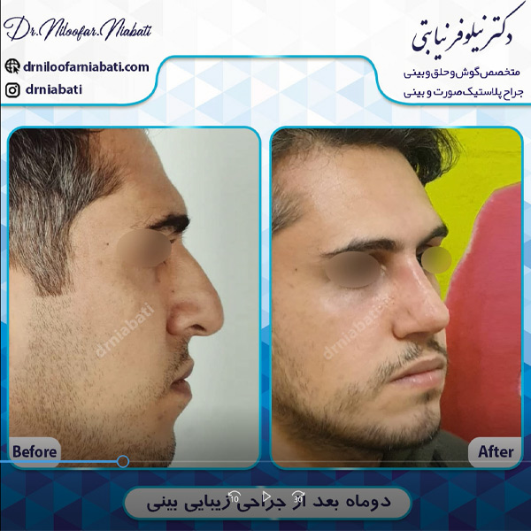 عکس قبل و بعد جراحی بینی در رامسر - دکتر نیابتی 