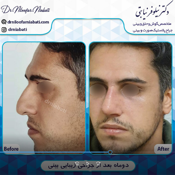 عکس قبل و بعد جراحی بینی در رامسر - عمل بینی مردانه - دکتر نیلوفر نیابتی -