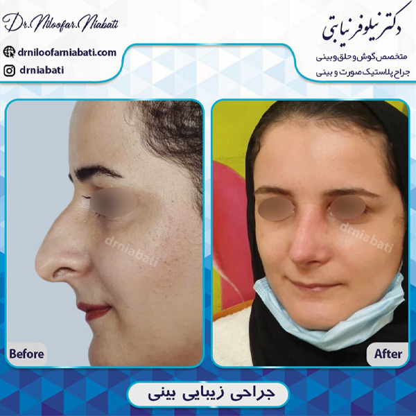 عکس قبل و بینی جراحی بینی زنانه در رامسر - دکتر نیابتی 