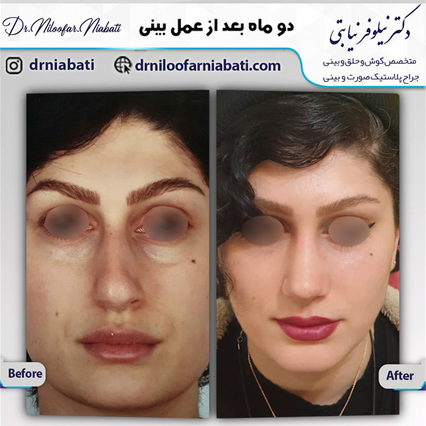 عکس قبل و بعد جراحی بینی در رامسر - دکتر نیابتی 