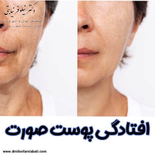 عکس افتادگی پوست صورت - دکتر نیلوفر نیابتی