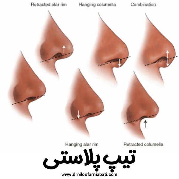 تیپ پلاستی - جراحی نوک بینی - دکتر نیلوفر نیابتی