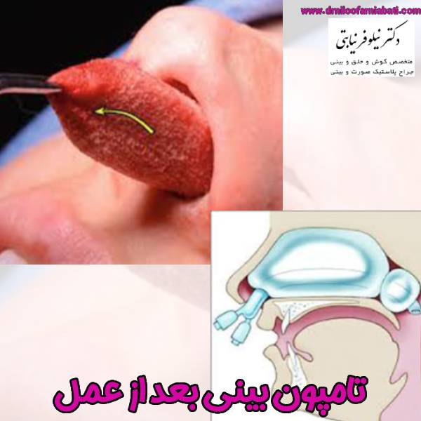 تامپون بینی بعد عمل - دکتر نیلوفر نیابتی