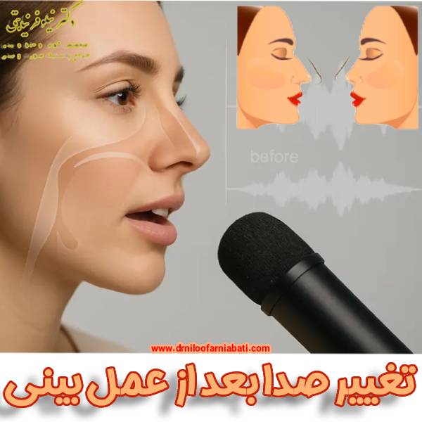 تغییر صدا بعد عمل بینی - دکتر نیلوفر نیابتی
