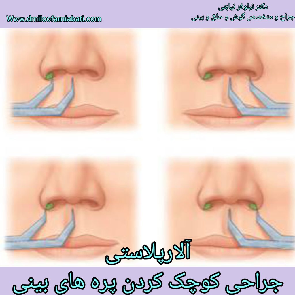 آلارپلاستی - دکتر نیلوفر نیابتی