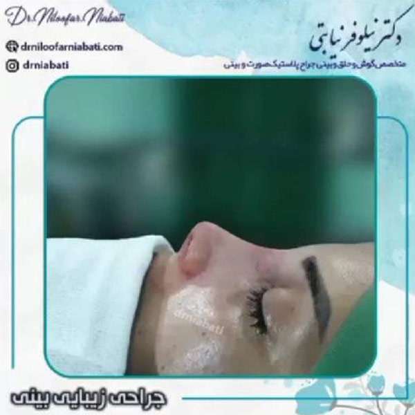 جراحی بینی نیمه فانتزی