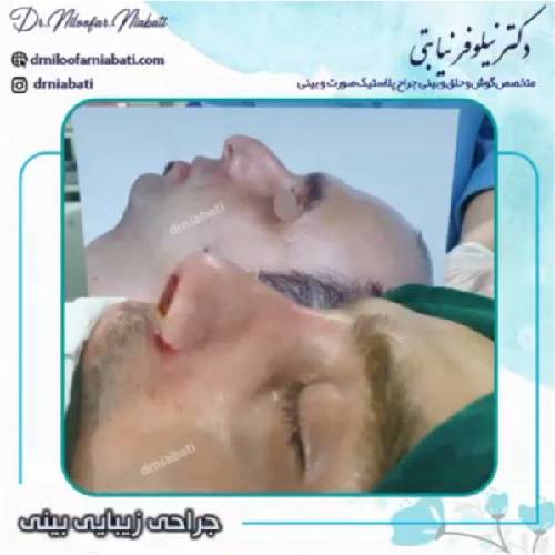 جراحی-بینی-225