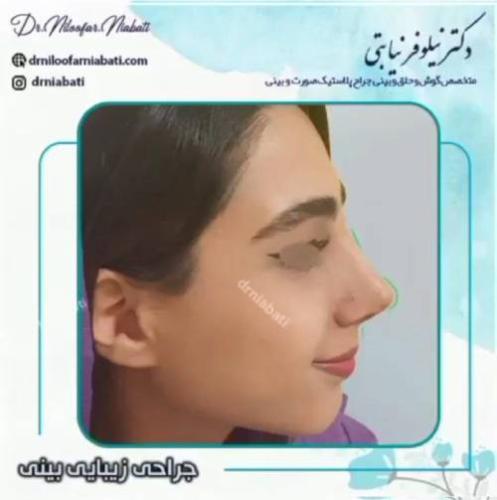 جراحی-بینی-226