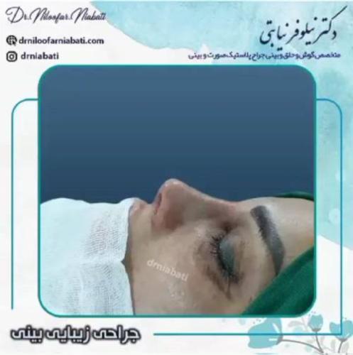 جراحی-بینی-228
