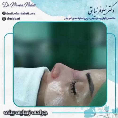 جراحی-بینی-229