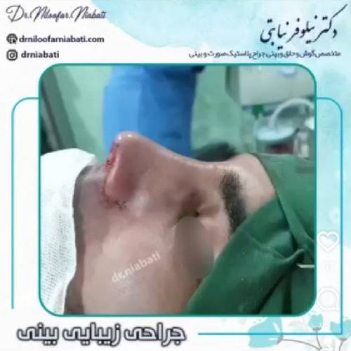 جراحی-بینی-231