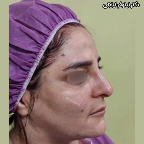 جراحی-بینی-232
