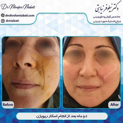 اسکار-ریویژن
