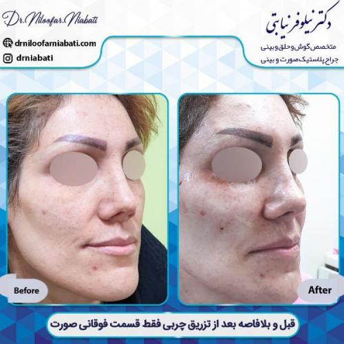 تزریق-چربی-مازندران-2-32