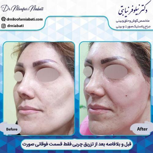 تزریق-چربی-مازندران-3-32