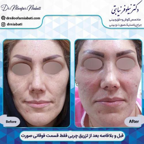 تزریق-چربی-مازندران-4-32