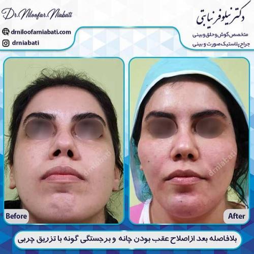 تزرریق-چربی-38