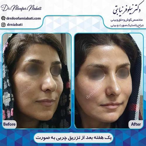 تزریق-چربی-35