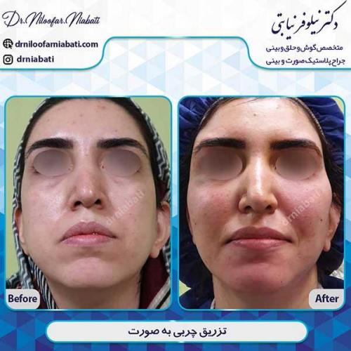 تزریق-چربی-45