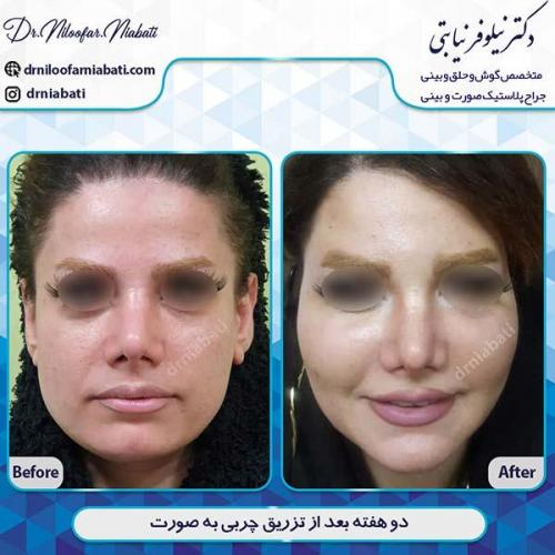 تزریق چربی 39