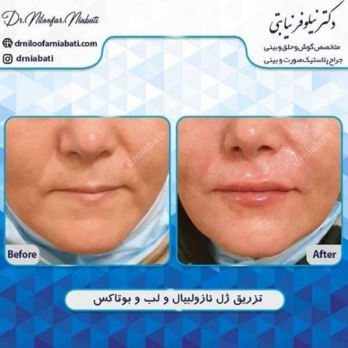 تزریق ژل و بوتاکس