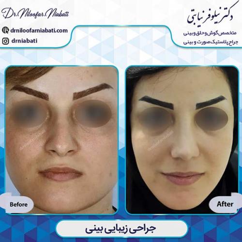 جراحی-بینی-3-27