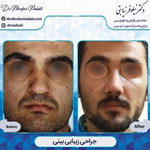 جراحی-بینی-1-28
