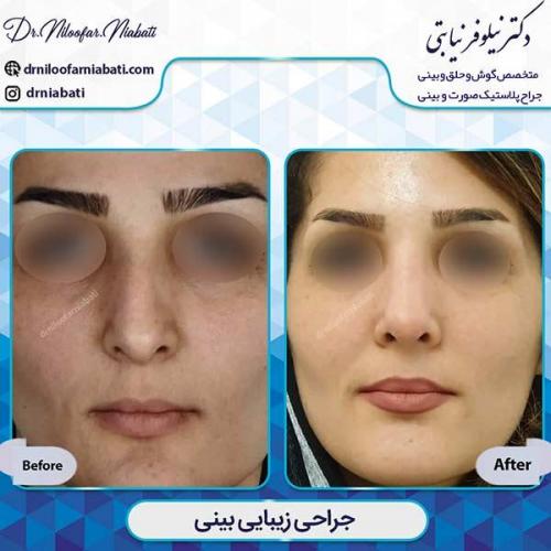 جراحی-بینی-1-30