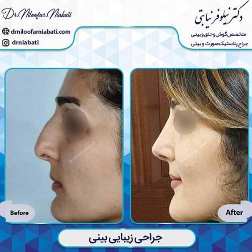 جراحی-بینی-2-30