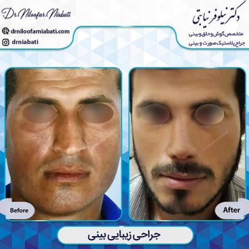 جراحی-بینی-1-32