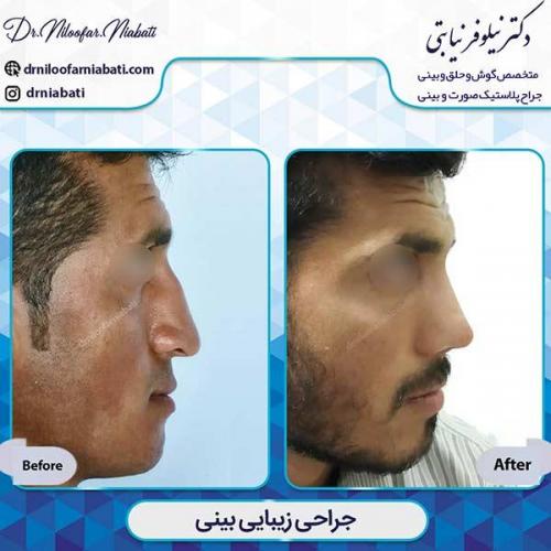 جراحی-بینی-21-32