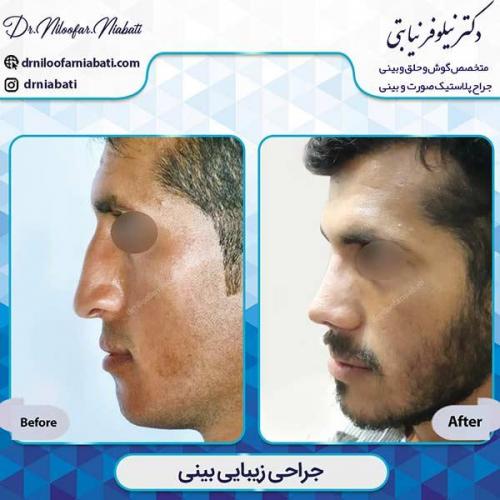 جراحی-بینی-3-32