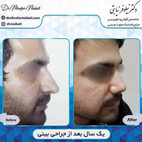 جراحی-بینی-1-38