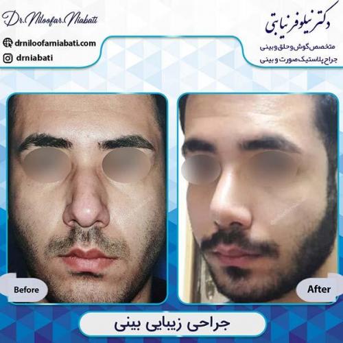 جراحی-بینی-34