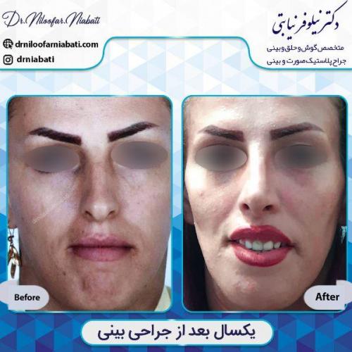 جراحی-بینی-3-40