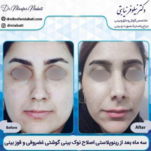 جراحی-بینی-21-42
