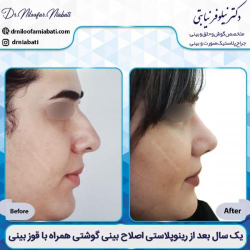 جراحی-بینی-2-44