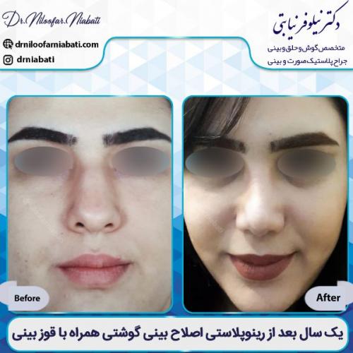 جراحی-بینی-3-44